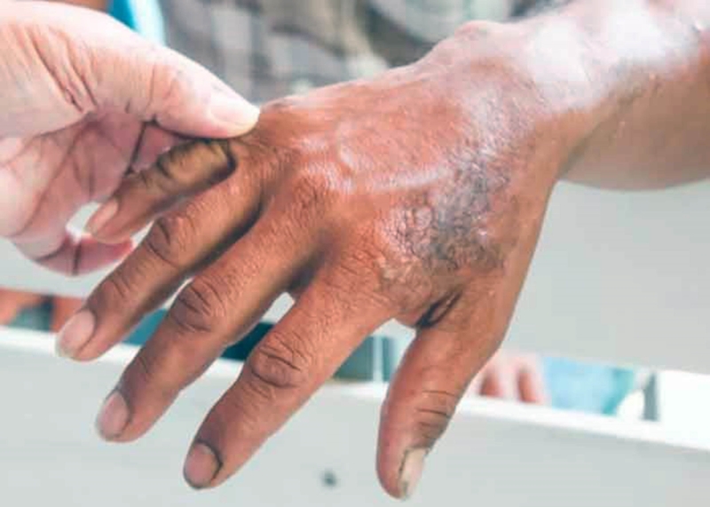 Lepra: prevenible y curable