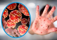 Suman 24 casos de viruela del mono en la entidad