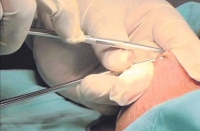 Promueve Issste vasectom&iacute;a sin bistur&iacute;