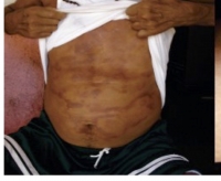 Se mantiene Yucat&aacute;n con tres casos de lepra