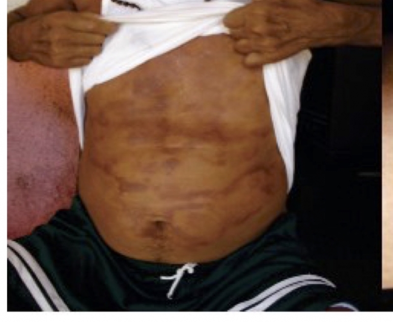 Se mantiene Yucatán con tres casos de lepra