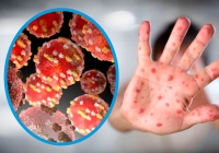 Suman 10 casos de viruela del mono en Yucatán; todos hombres